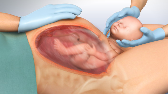 Project Postpartum Hemorrhage