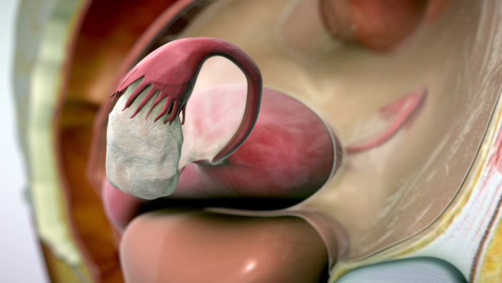 Treating Endometriosis