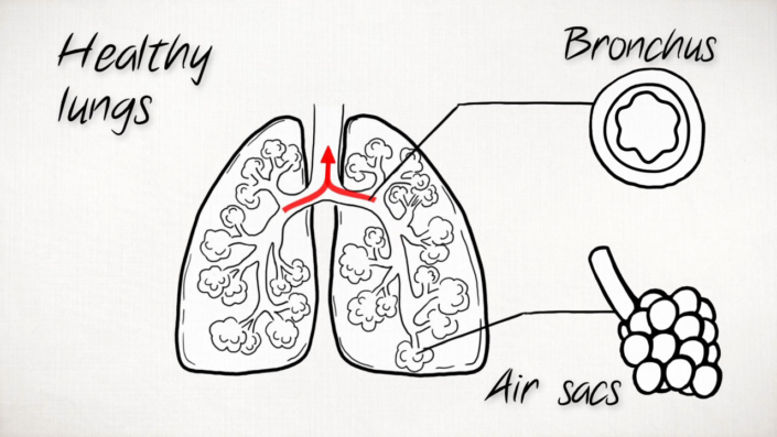 What is COPD?