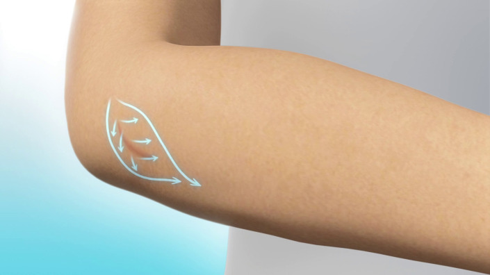 Scar Treatment Scar Treatment