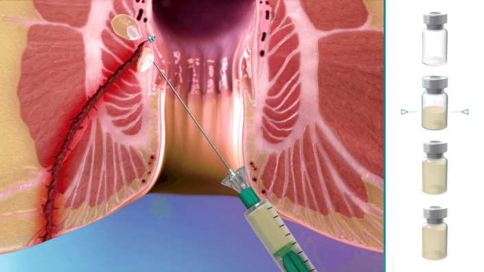 Mode of Administration – Perianal Fistula